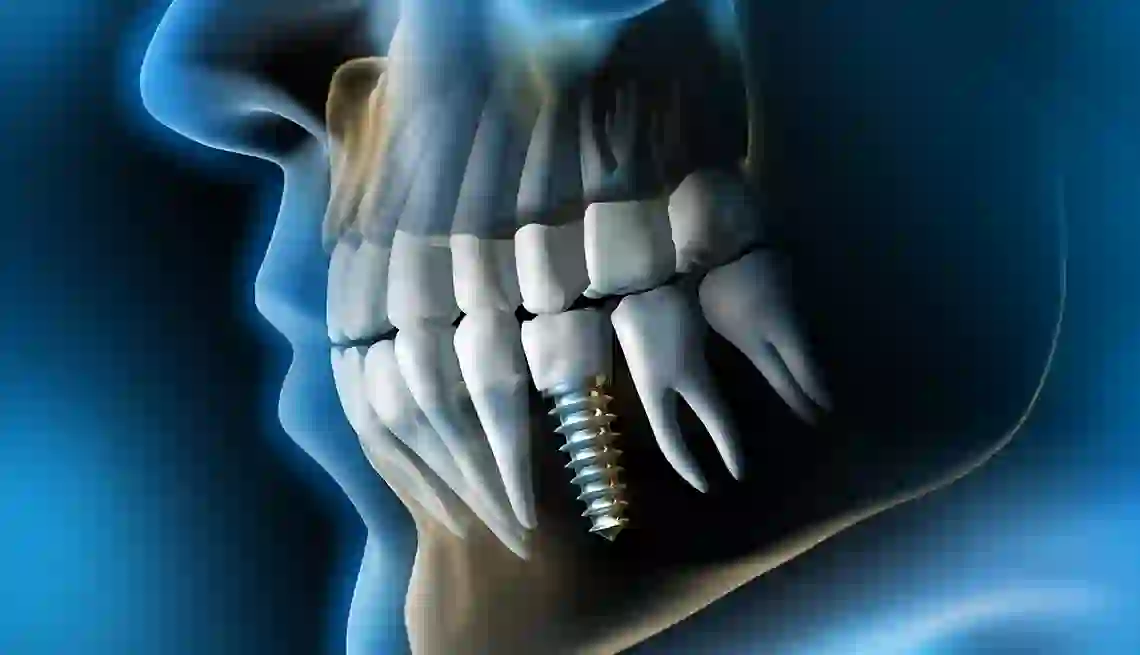 What to Expect During Dental Implant Treatment